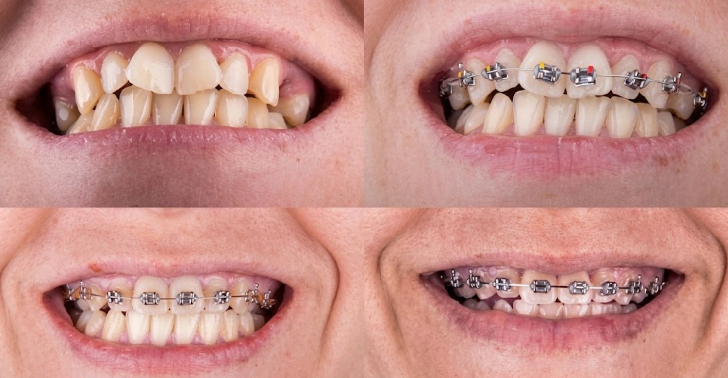 Amazing Orthodontic Braces in Turkey Inblog